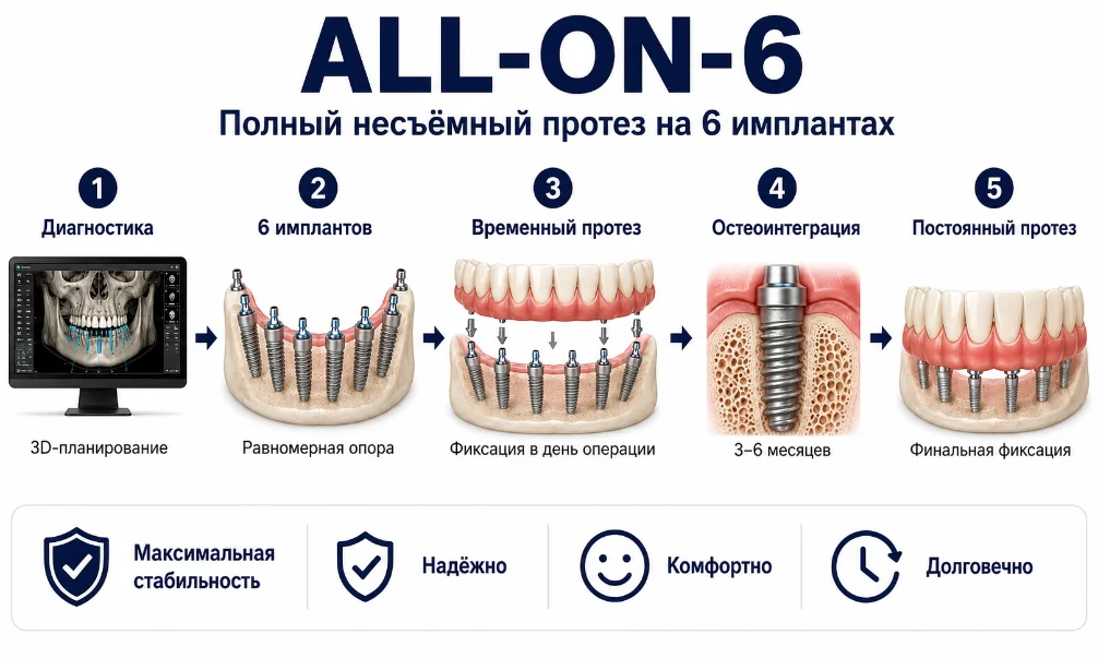 All-on-6 — шесть имплантов для максимальной опоры — стоматология NuAnce