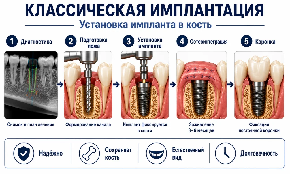 Классическая двухэтапная имплантация — стоматология NuAnce